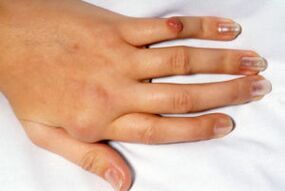 deformed finger pain