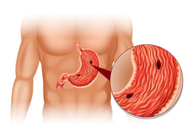 ulcer as the cause of pain under the left shoulder blade