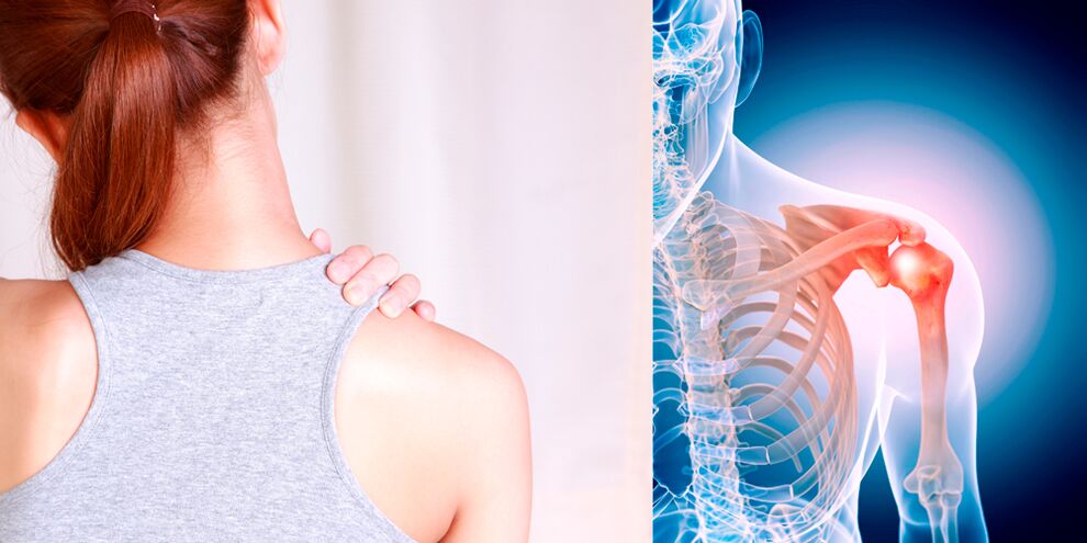 The development of osteoarthritis of the shoulder gradually leads to permanent pain