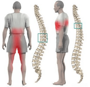 back pain in chest osteochondrosis