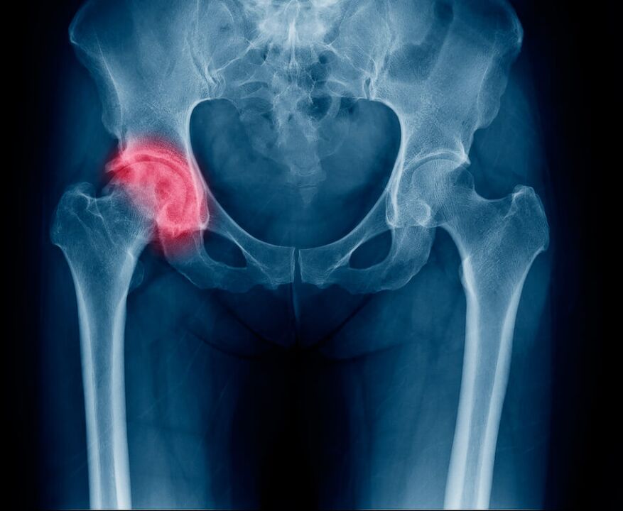 Fracture of the femoral neck causing pain radiating down the leg