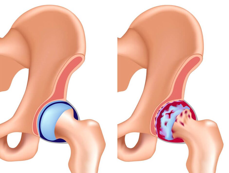 The most common cause of hip joint pain is coxarthrosis. 