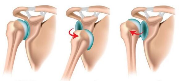 Anterior and posterior dislocation of the shoulder joint, which provokes the development of arthrosis