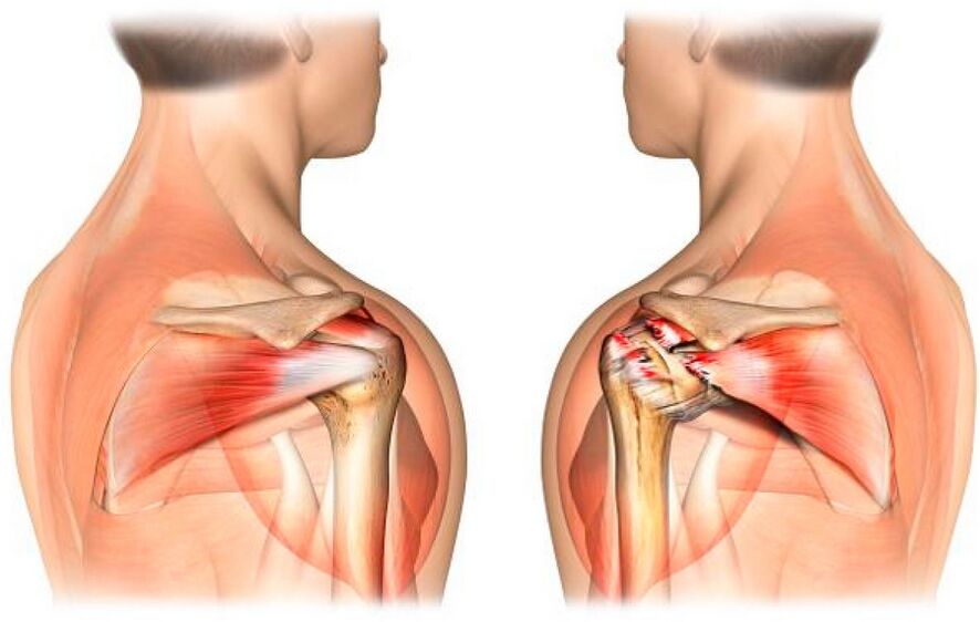 Healthy and shoulder affected by arthrosis