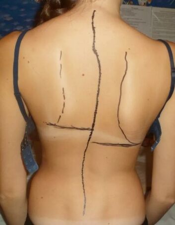 Hump