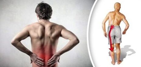 Lumbar osteochondrosis pain syndrome radiates to the legs