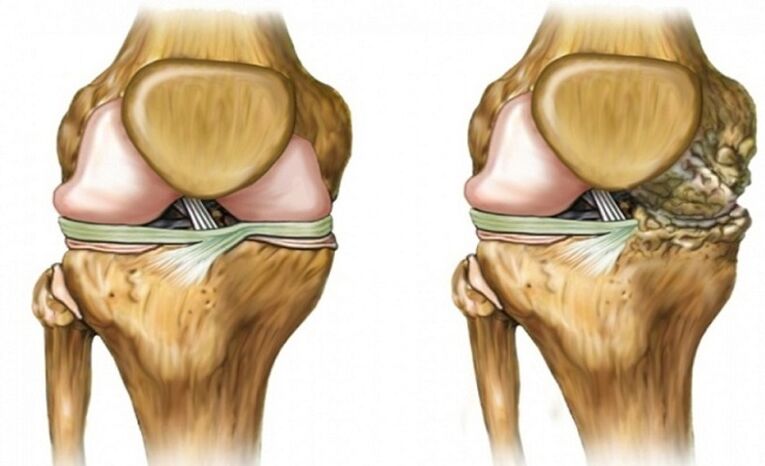 Healthy and affects arthrosis joint