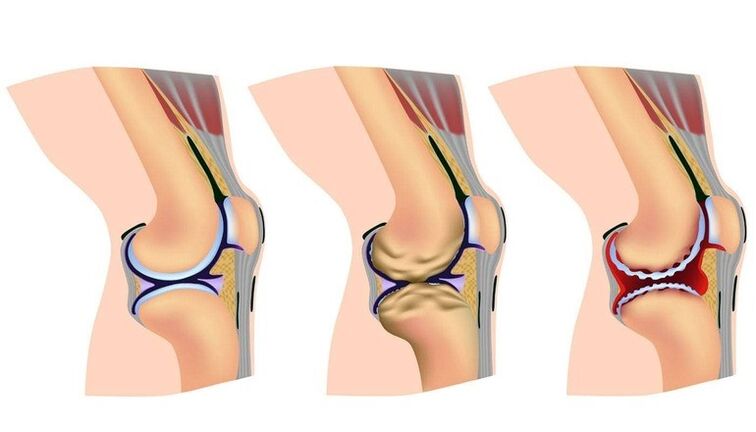 Stages of deformation of knee joints for joint joints