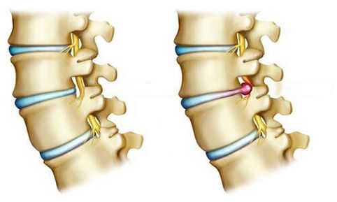 healthy disc and herniated disc