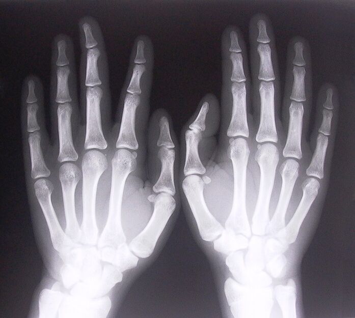 X-ray is a way to diagnose pain in the joints of the fingers