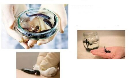 arthrosis hirudotherapy